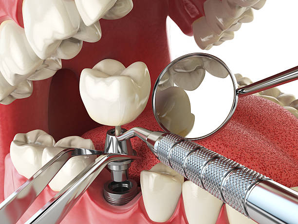 Best Broken or Chipped Tooth Repair in Moody, AL